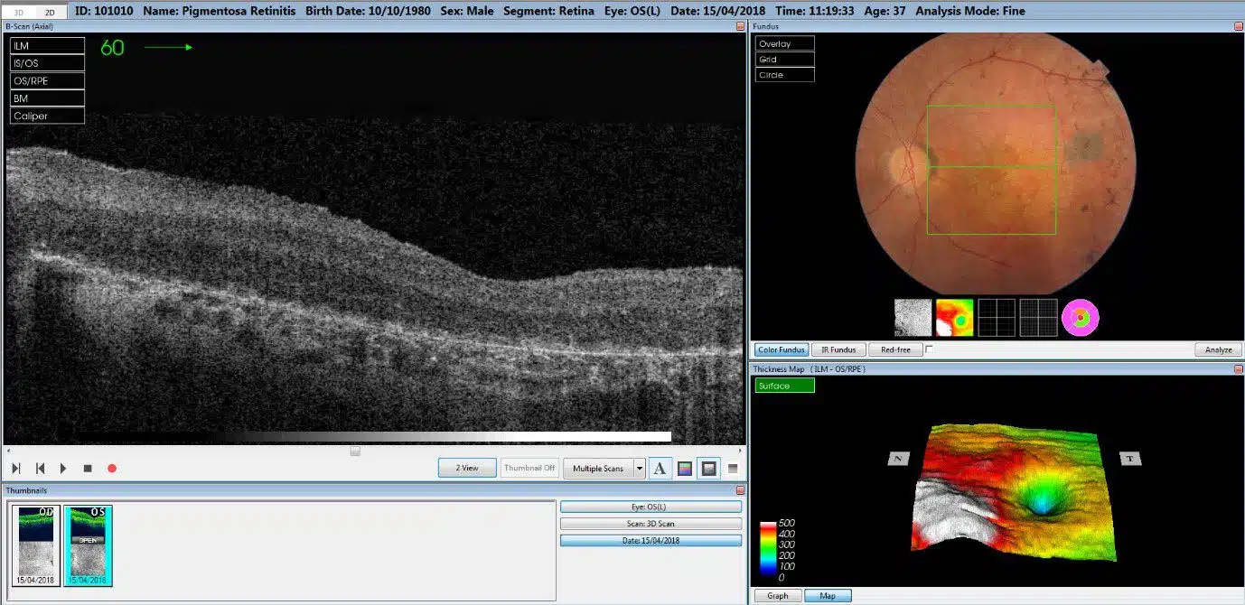 Scan Life Beyond the OCT (Optical Coherence Tomography) Scan