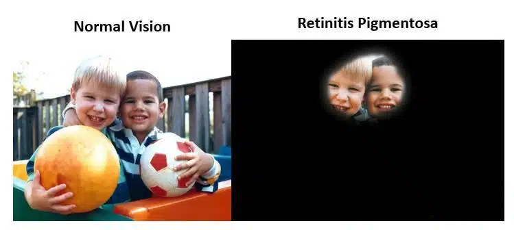 RP vision comparison Dealing with Sight Loss: Being Blind in Business RP vision comparison Dealing with Sight Loss: Being Blind in Business
